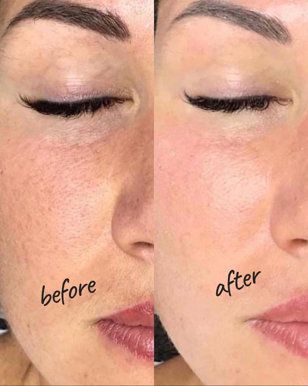 Biorevitalization Result — Hydrated Glowing Skin NYC
